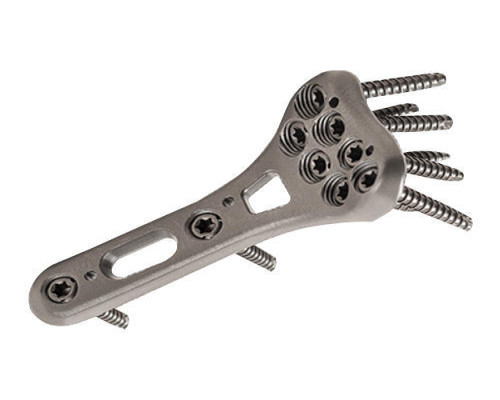 Read This Before Buying an Orthopedic Locking Plate