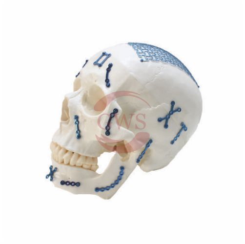 Maxillofacial Implants Manufacturers