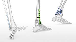 How To Make Orthopedic Implants Safe and Risk Free For Patients